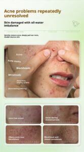 acne scars skin care products